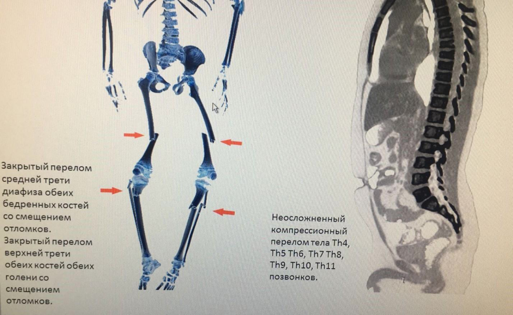 Врачи больницы провели операцию ребенку, который получил множественные переломы ног в результате ДТП