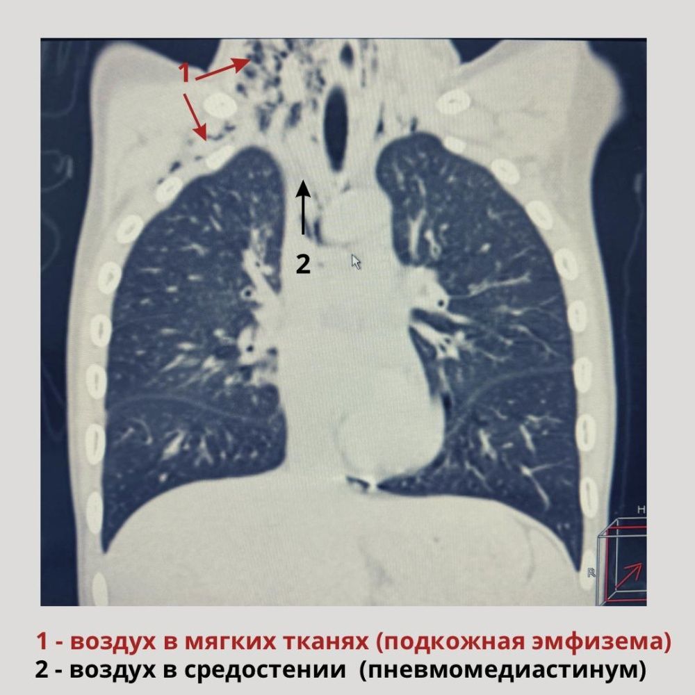 Аллергия на кошку стала причиной возникновения пневмомедиастинума! 